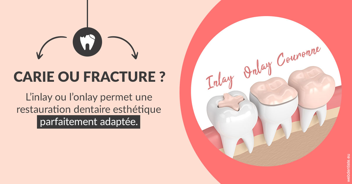 https://dr-veronique-amard.chirurgiens-dentistes.fr/T2 2023 - Carie ou fracture 2