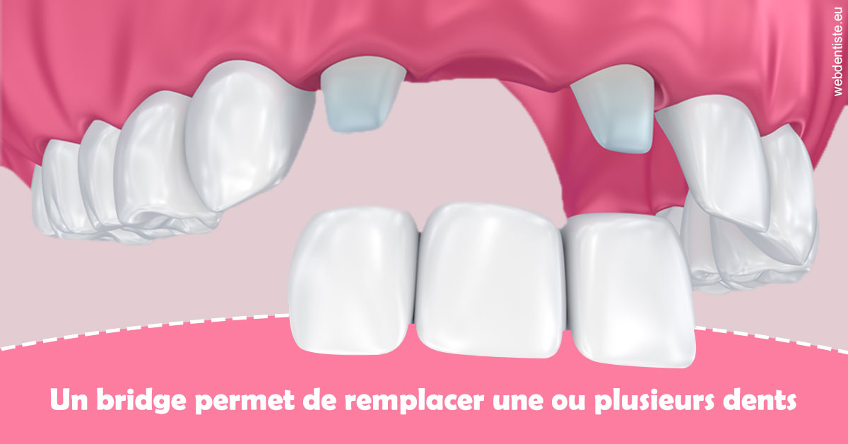 https://dr-veronique-amard.chirurgiens-dentistes.fr/Bridge remplacer dents 2