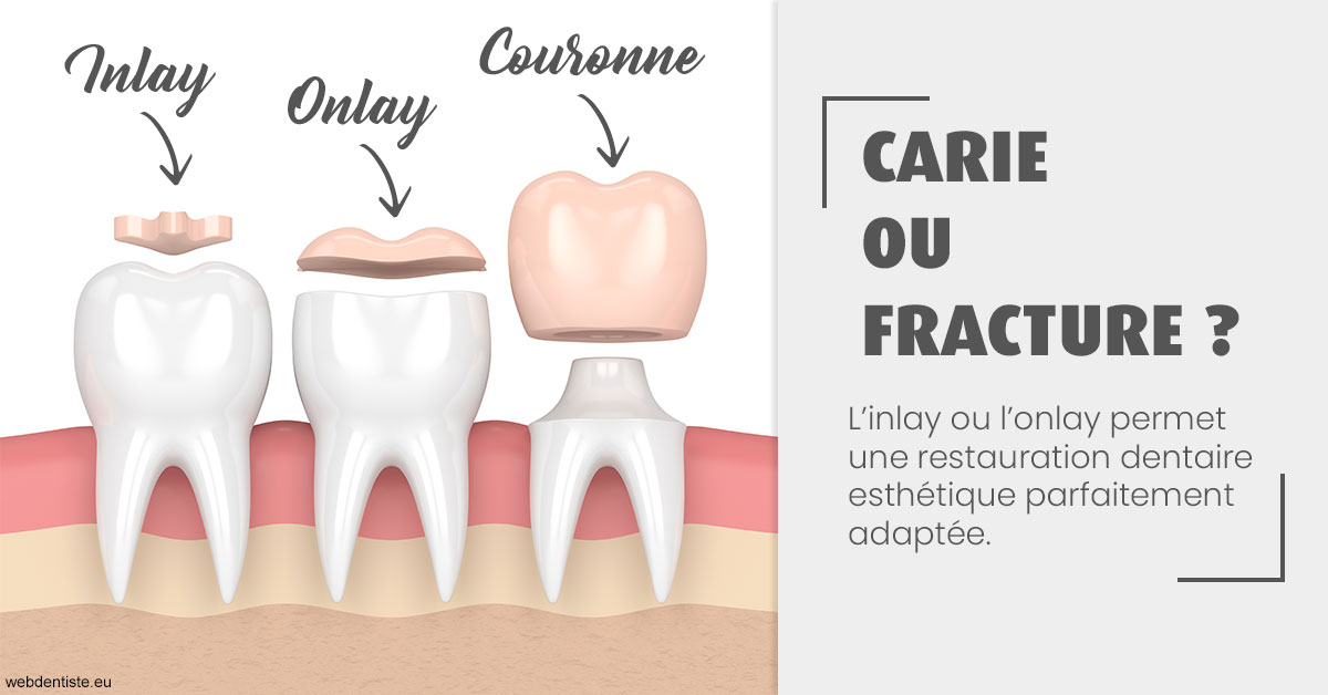 https://dr-veronique-amard.chirurgiens-dentistes.fr/T2 2023 - Carie ou fracture 1