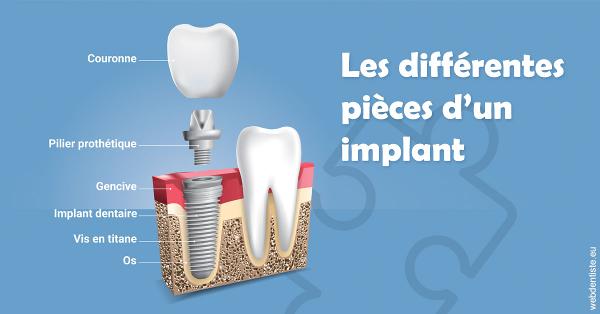 https://dr-veronique-amard.chirurgiens-dentistes.fr/Les différentes pièces d’un implant 1